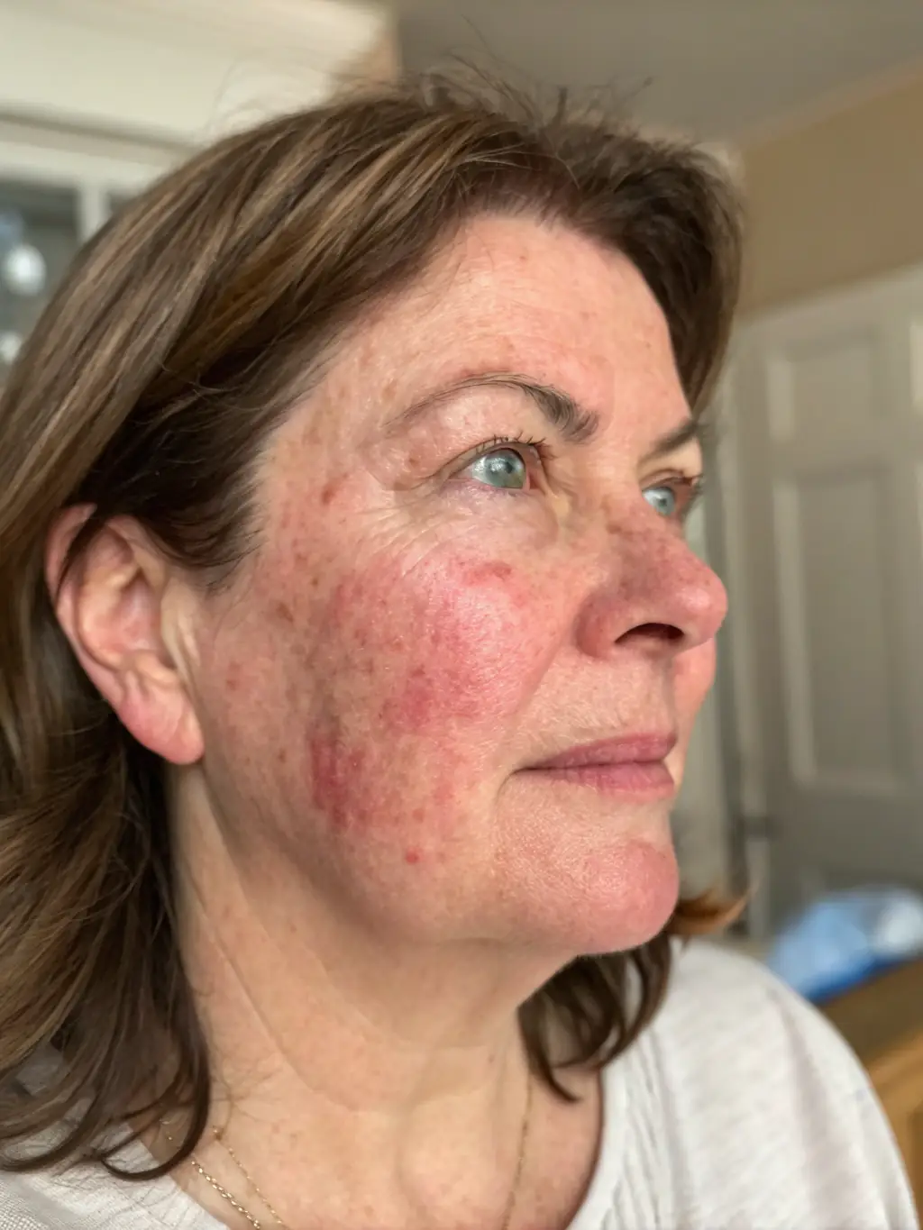 Image of a patient's face before and after rosacea treatment, demonstrating the effectiveness of the clinic's rosacea management.